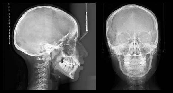 Telerradiografía Frontal de Cráneo
